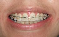 Transparente Brackets