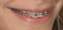 Minibrackets